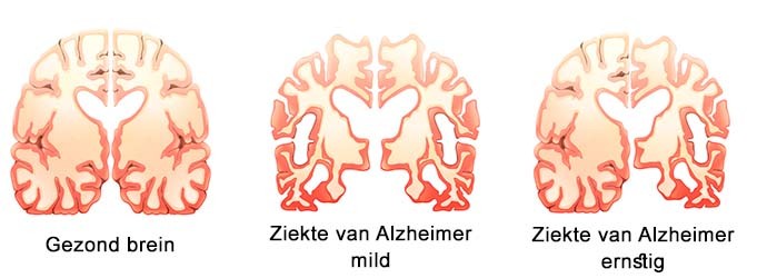 Het brein bij de ziekte van Alzheimer