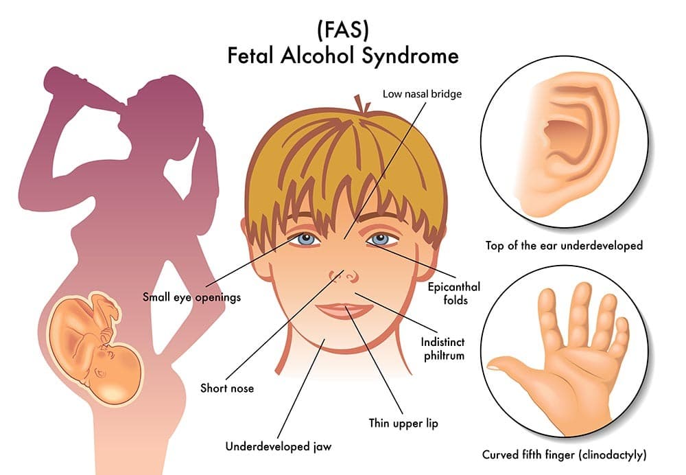 Foetaal Alcohol Syndroom infographic